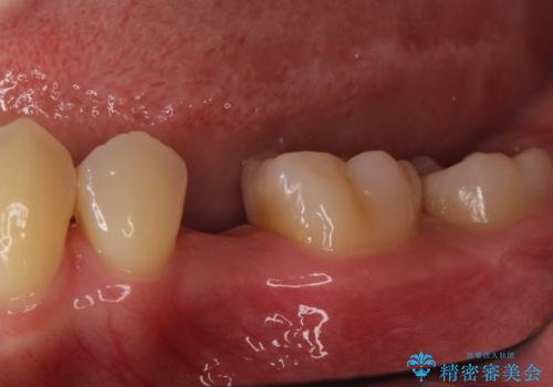 小臼歯のインプラントの治療前