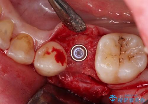 小臼歯のインプラントの治療中