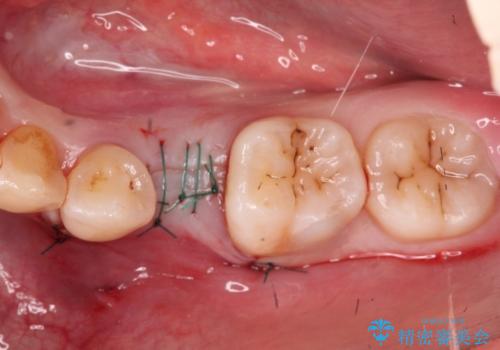 小臼歯のインプラントの治療中