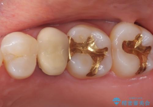 【セラミッククラウン】他院で入れた被せ物を変えたい。の治療前