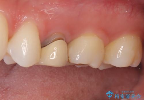 【セラミッククラウン】他院で入れた被せ物を変えたい。の治療前