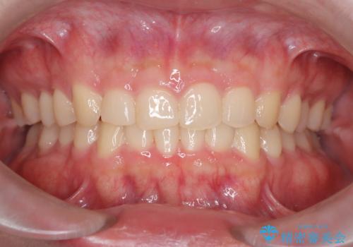 【インビザライン】前歯のガタガタと、前歯の噛み合わせが深いことを治したい。の症例 治療後