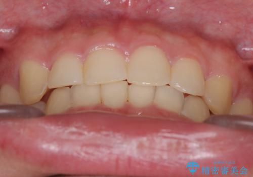 【インビザライン】前歯のガタガタと、前歯の噛み合わせが深いことを治したい。の治療後