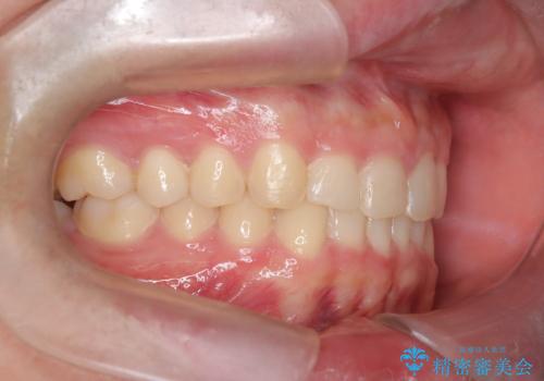 【インビザライン】前歯のガタガタと、前歯の噛み合わせが深いことを治したい。の治療後