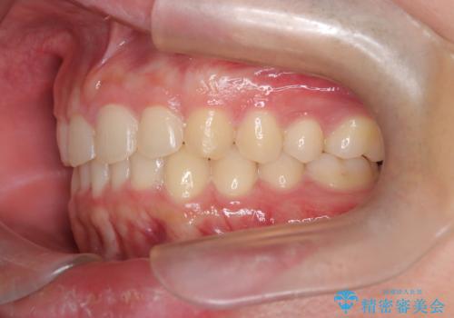 【インビザライン】前歯のガタガタと、前歯の噛み合わせが深いことを治したい。の治療後