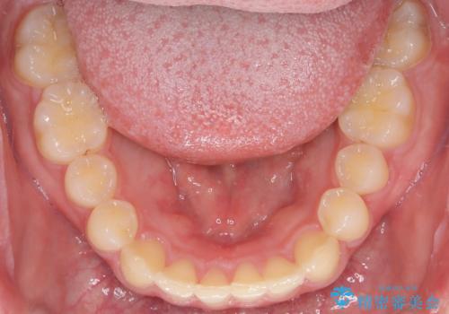 【インビザライン】前歯のガタガタと、前歯の噛み合わせが深いことを治したい。の治療後