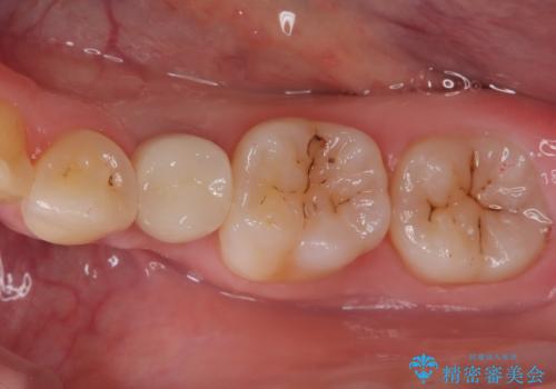 小臼歯のインプラントの治療後