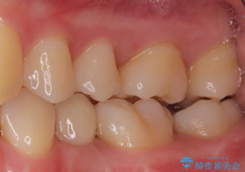 小臼歯のインプラントの治療後
