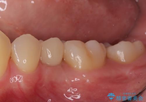 小臼歯のインプラントの治療後