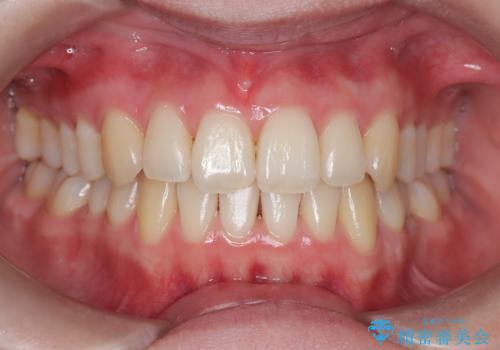 【インビザライン】 前歯の反対咬合を治したいの治療後