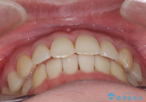 【インビザライン】 前歯の反対咬合を治したいの治療後