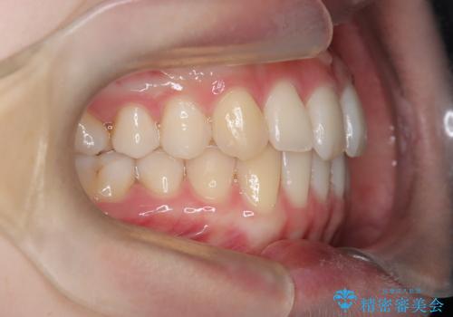 【インビザライン】 前歯の反対咬合を治したいの治療後