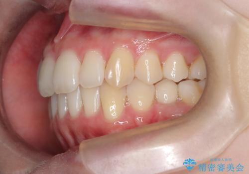 【インビザライン】 前歯の反対咬合を治したいの治療後
