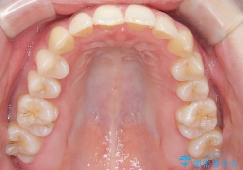 【インビザライン】 前歯の反対咬合を治したいの治療後