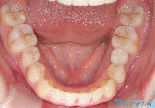 【インビザライン】 前歯の反対咬合を治したいの治療後
