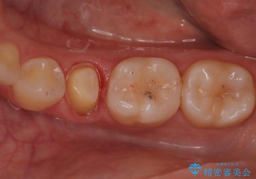 【オールセラミッククラウン】根管治療した歯の被せ物治療の治療中