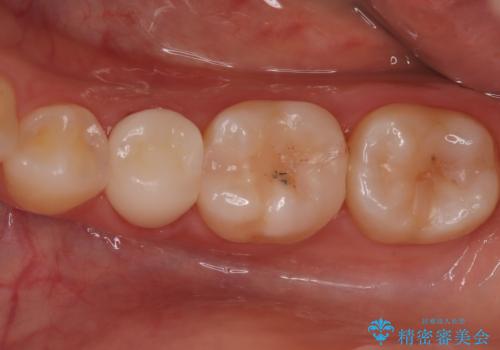【オールセラミッククラウン】根管治療した歯の被せ物治療の症例 治療後