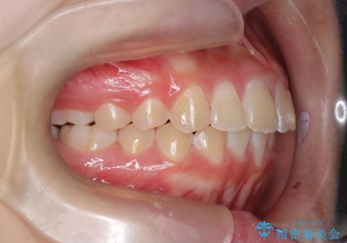 【インビザライン】前歯を下げたいの治療後