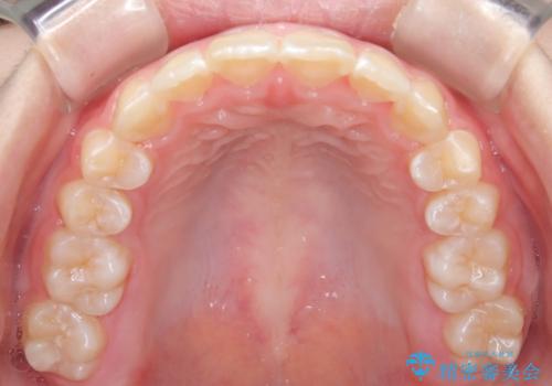 【インビザライン】前歯を下げたいの治療後