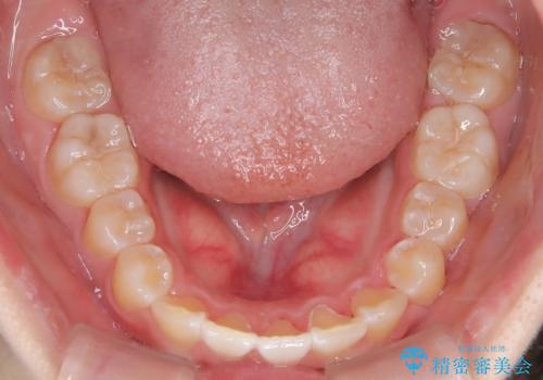【インビザライン】前歯を下げたいの治療後