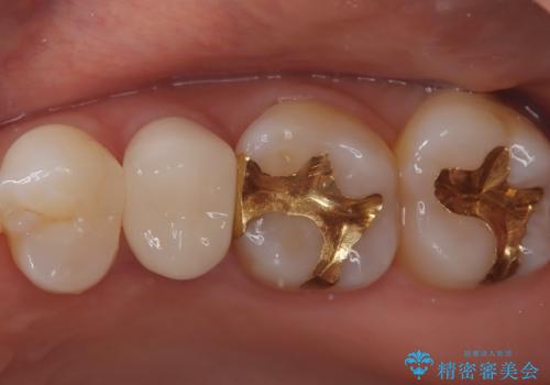 【セラミッククラウン】他院で入れた被せ物を変えたい。の治療後