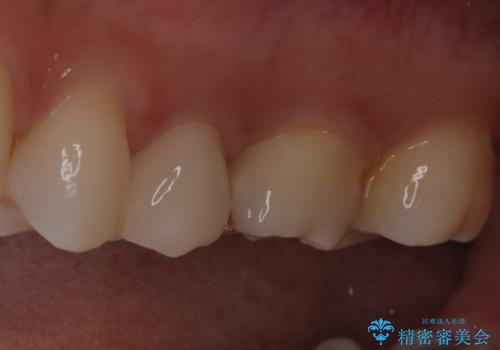 【セラミッククラウン】他院で入れた被せ物を変えたい。の治療後