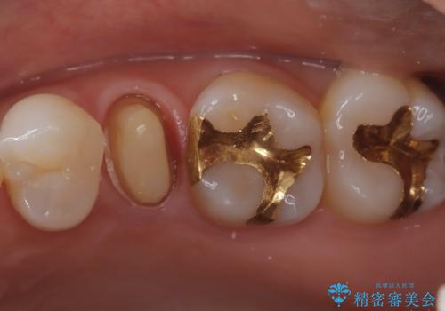 【セラミッククラウン】他院で入れた被せ物を変えたい。の治療中