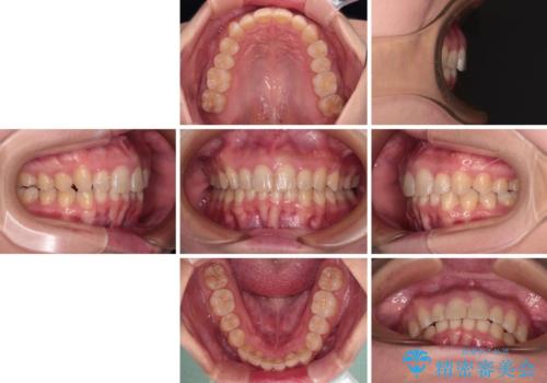 上の出っ歯を治したい インビザラインによる矯正治療の治療後