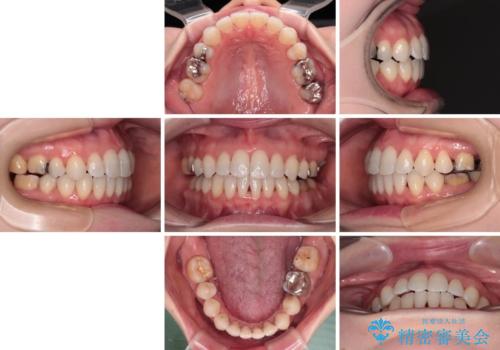 大きなむし歯の奥歯を抜歯してスペースを活用　ワイヤー装置による抜歯矯正の治療後