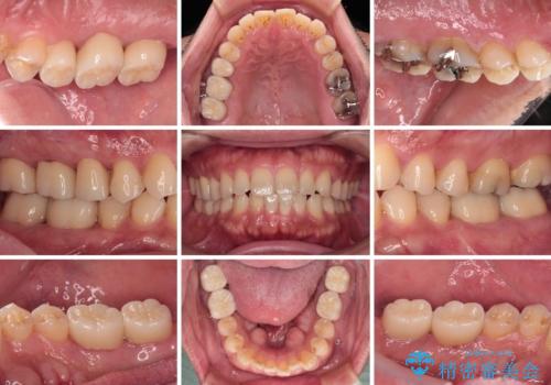 歯肉が腫れて出血する奥歯 歯周外科処置を用いたセラミック補綴治療の治療後