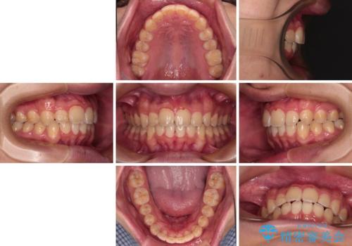 【モニター】飛び出した上の前歯 ワイヤー装置を併用してインビザラインできれいにの治療後