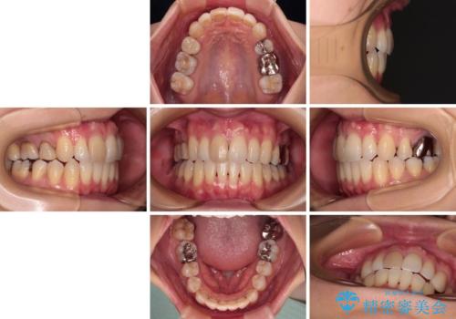 V字型に飛び出した前歯 ワイヤー装置での抜歯矯正の治療後