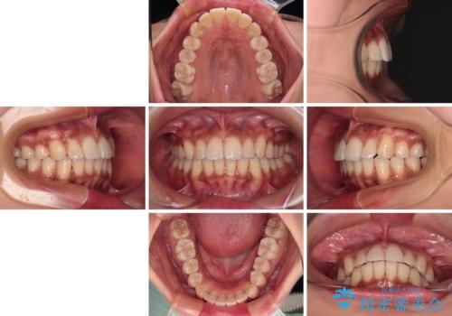 カリエール・ディスタライザーを併用したインビザライン矯正治療の治療後