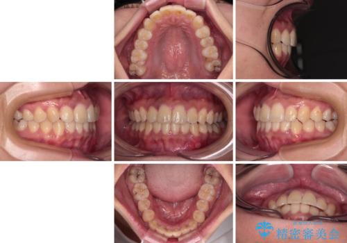 前歯のデコボコと隠れてしまう下顎前歯 インビザラインですっきりと改善の治療前