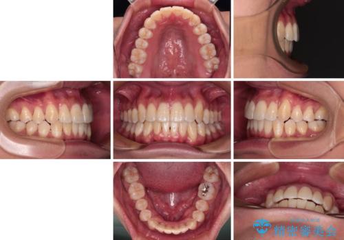 補助装置を併用してスムーズに インビザラインによる矯正治療の治療後