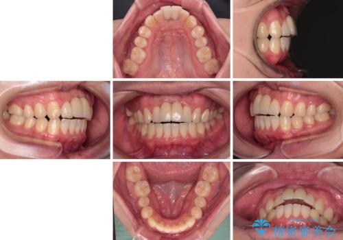 下顎前歯の部分矯正 目立たないワイヤー装置の治療後