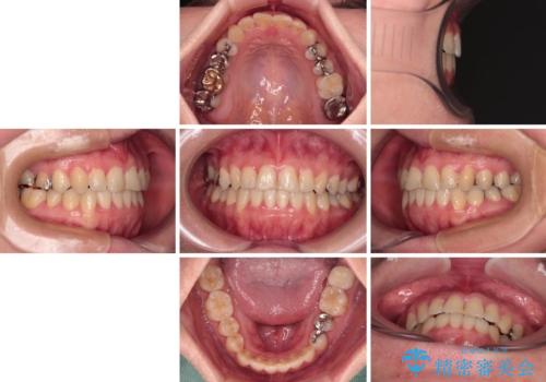 気になる歯列不正とむし歯を治療　インビザライン治療と虫歯治療の治療後