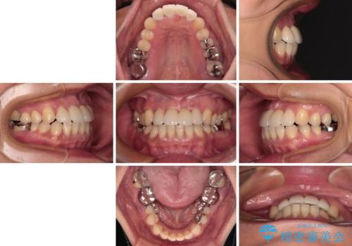 中途半端な矯正治療と前歯の欠損 再矯正とオールセラミッククラウンによる補綴治療の治療後