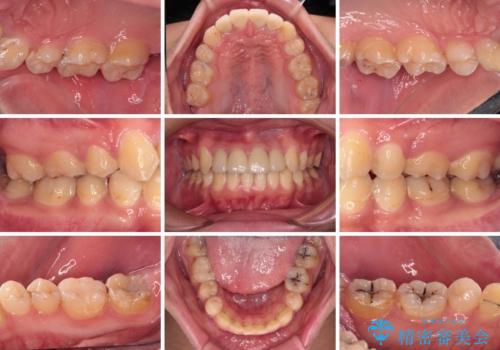 前歯のデコボコとむし歯だらけの歯列 矯正治療と虫歯治療の治療後