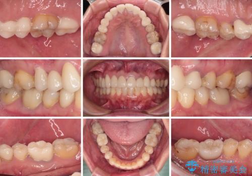 欠損やむし歯の歯をきれいなセラミックに 全顎虫歯治療の治療後