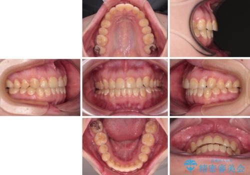 前歯のクロスバイトを改善 ワイヤー矯正を併用したインビザライン矯正の治療後