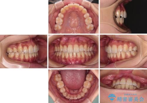 目立たないハーフリンガル矯正 抜歯矯正で口元の突出感を改善の治療後