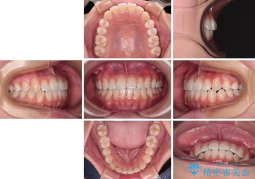 前歯のデコボコを楽して改善 ワイヤー装置による矯正治療の治療後