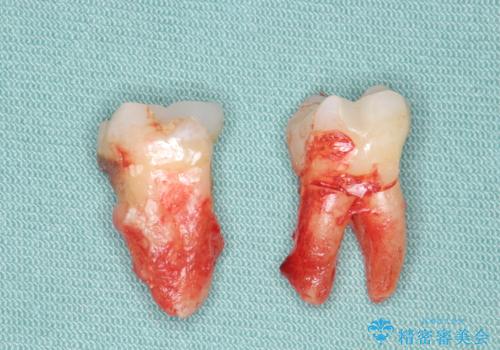 歯周病により抜去した歯のインプラント治療の治療前
