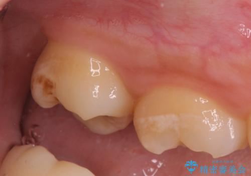歯の高さを出すための親知らず抜歯と歯肉切除の治療後
