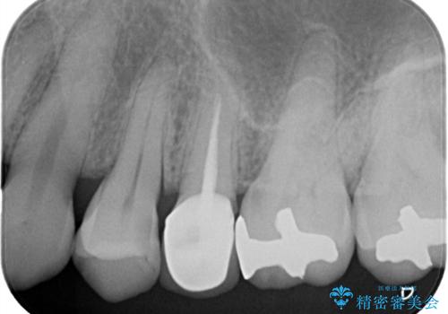 【セラミッククラウン】他院で入れた被せ物を変えたい。の治療前