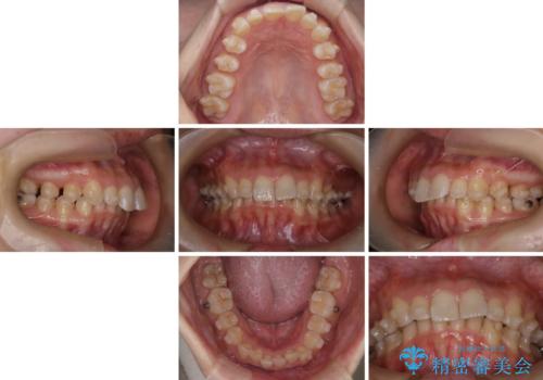 上の出っ歯を治したい インビザラインによる矯正治療の治療中