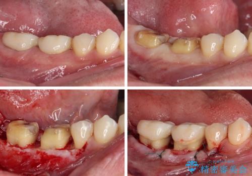 歯肉が腫れて出血する奥歯　歯周外科処置を用いたセラミック補綴治療の治療中