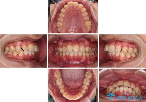 【モニター】飛び出した上の前歯 ワイヤー装置を併用してインビザラインできれいにの治療中