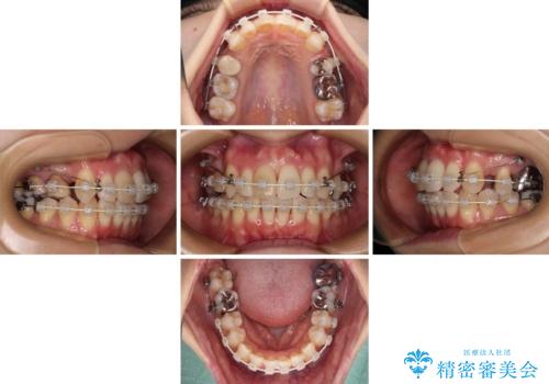 V字型に飛び出した前歯 ワイヤー装置での抜歯矯正の治療中
